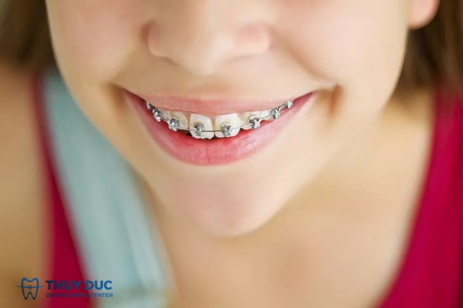 Có nhất thiết phải nhổ răng khi niềng răng cho trẻ? 1