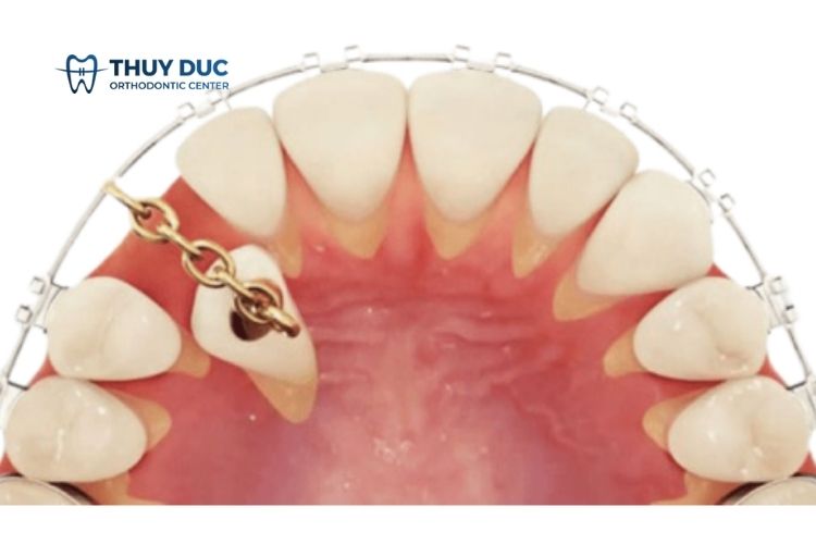 Răng mọc ngầm 1