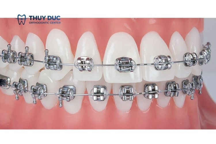 Phương pháp niềng răng - chỉnh nha 1