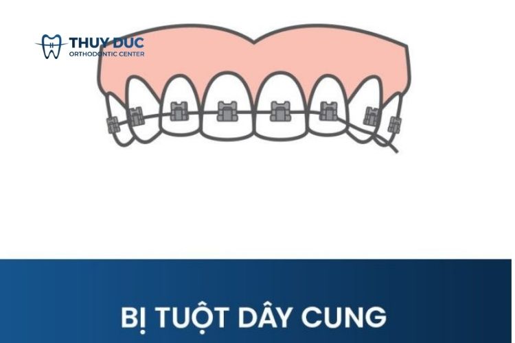 Tuột dây cung 1