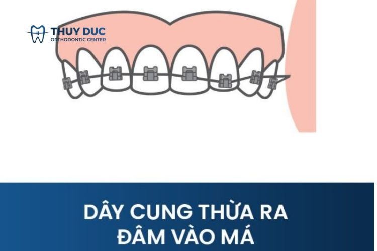 Dây cung chọc vào má 1
