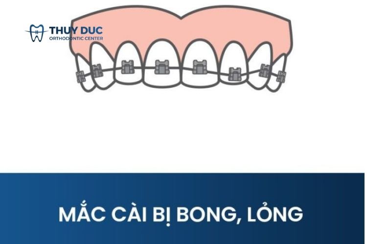 Dây cung, mắc cài bị bong, lỏng 1