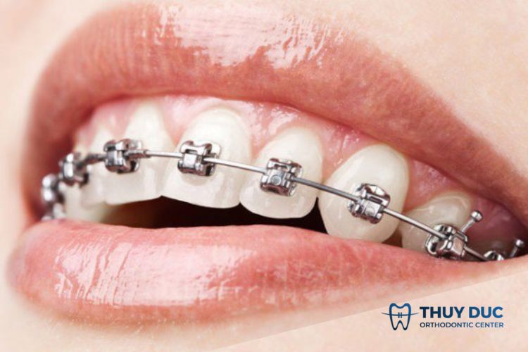 Phương pháp niềng răng thưa bằng mắc cài 2