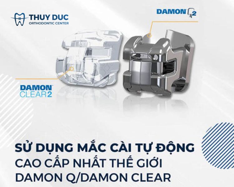 Niềng răng mắc cài tự buộc có tốt không? Nên dùng mắc cài sứ hay kim loại 1