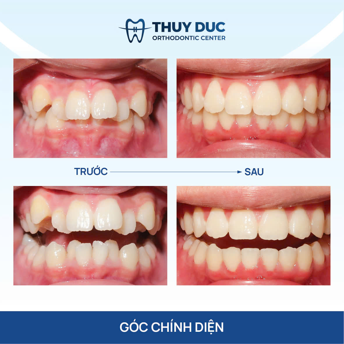 Răng khấp khểnh, chen chúc 1