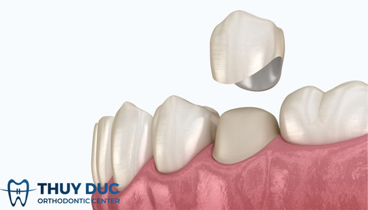 Nguyên nhân bọc răng sứ bị tụt nướu và cách khắc phục 1
