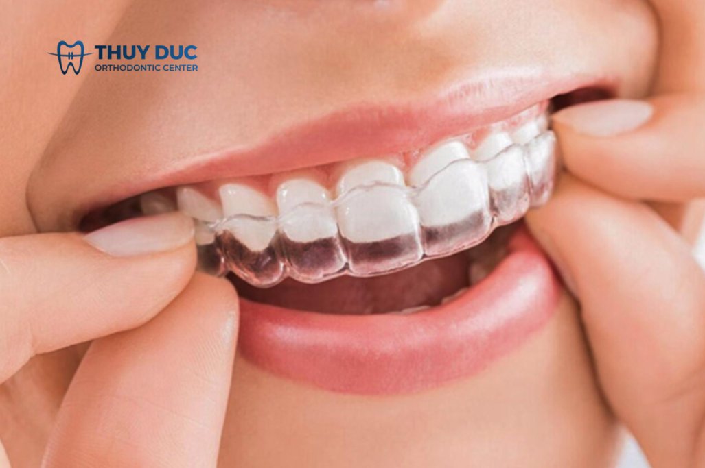 Ưu điểm của phương pháp chỉnh nha 1