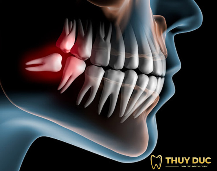 Chụp X – quang răng khôn có ảnh hưởng gì không? 1