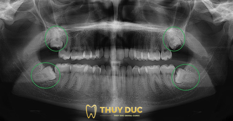 Tại sao bắt buộc phải chụp X – quang răng khôn? 1