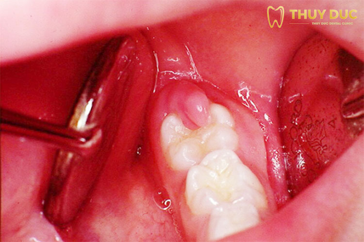 Viêm lợi trùm răng khôn có mủ là gì? 1