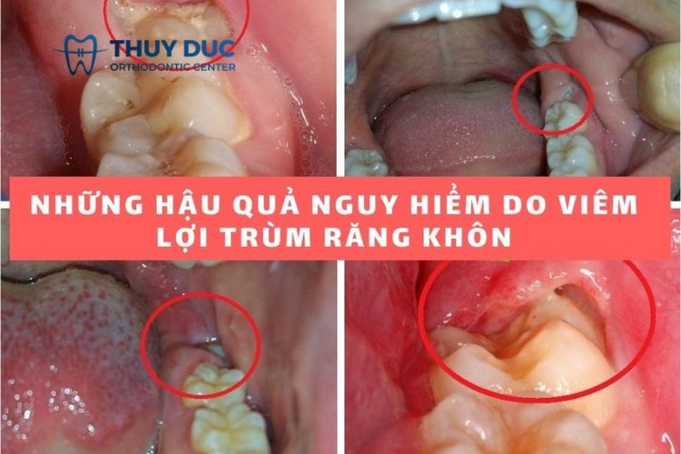 Những biến chứng của lợi trùm răng khôn 1
