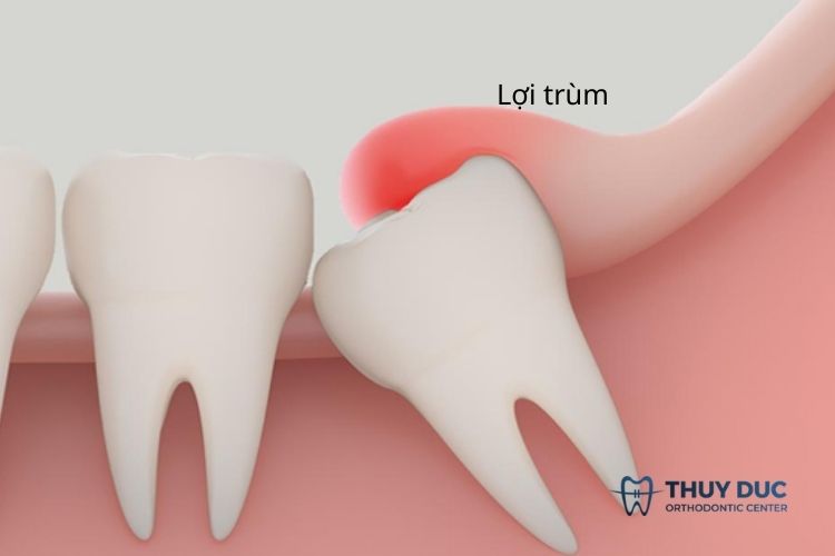 Giải đáp lợi trùm răng khôn là gì? 1