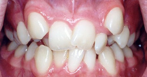 Thế nào là răng lòi xỉ? Điều trị răng lòi xỉ như thế nào? 1