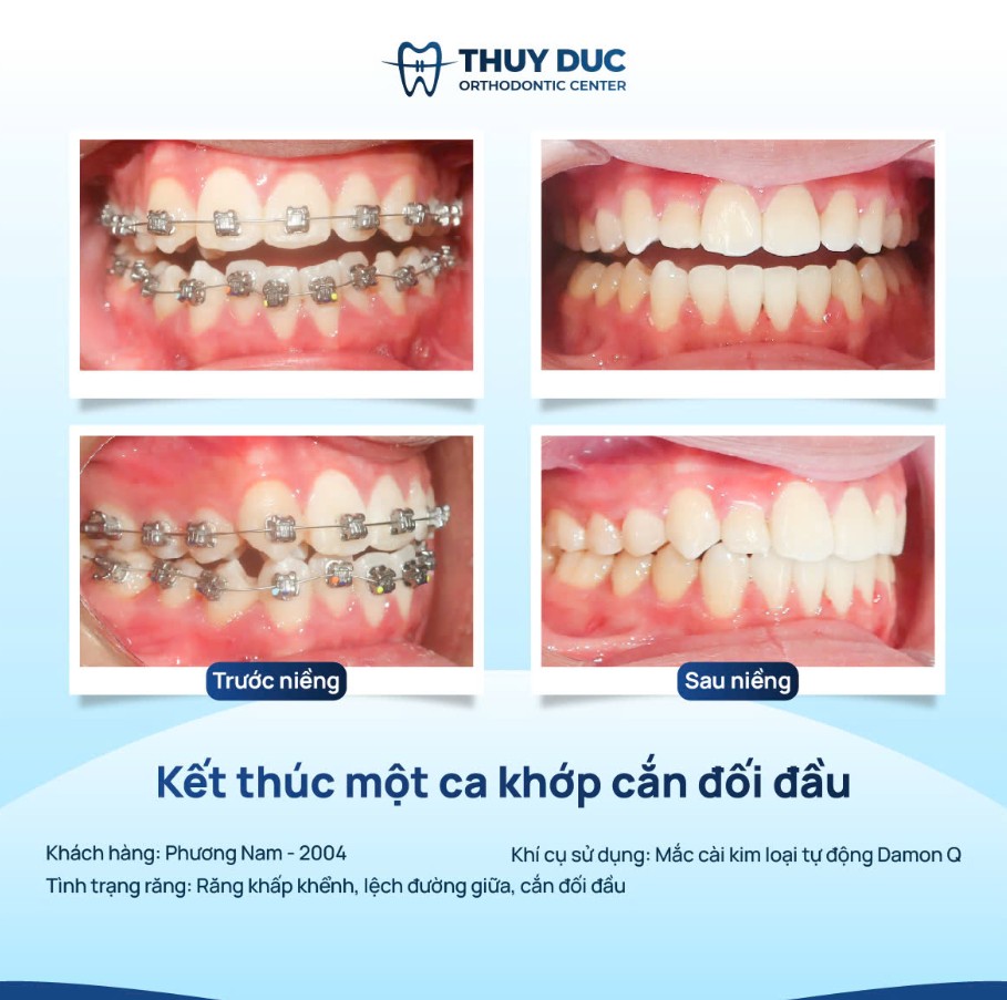 Niềng răng khớp cắn đối đỉnh 1 Niềng răng khớp cắn đối đỉnh 1