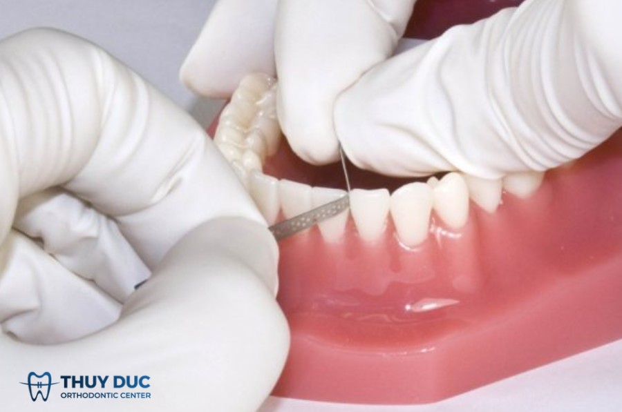 Dụng cụ nào thường dùng để mài kẽ răng 1