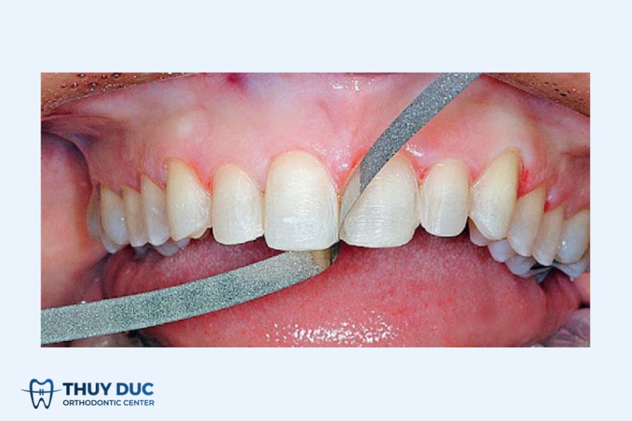 Giải đáp cụ thể mài kẽ răng là gì? 1