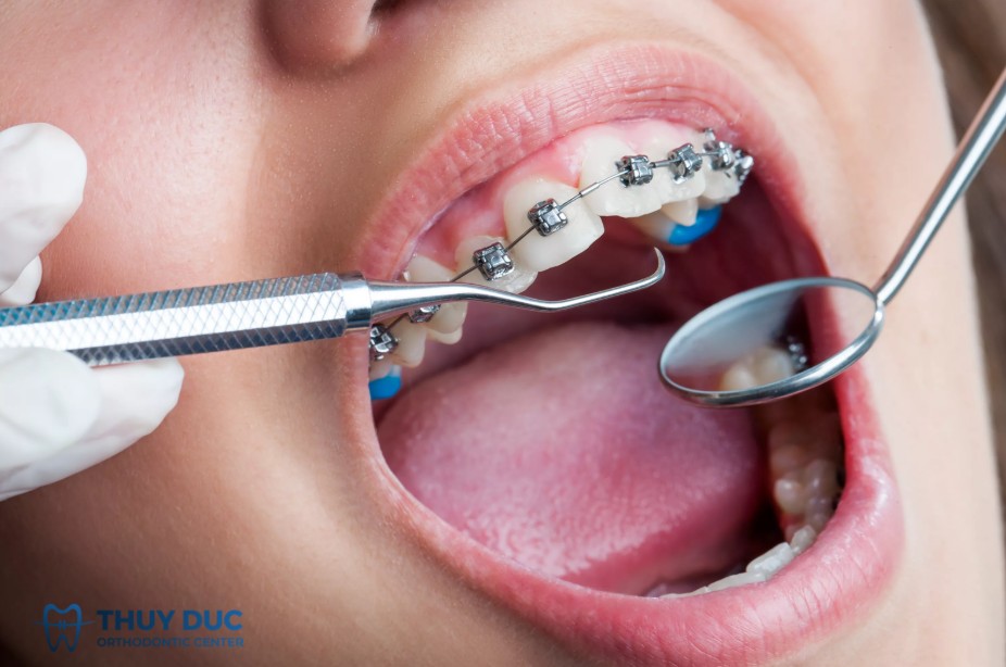 Cách khắc phục răng cửa lung lay khi niềng 1