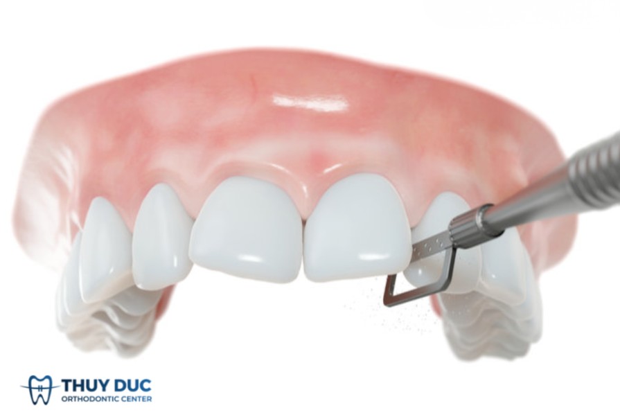 Những câu hỏi liên quan đến mài kẽ răng 1