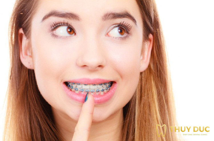  Niềng răng răng bị lung lay : Giải pháp hiệu quả cho vấn đề của bạn