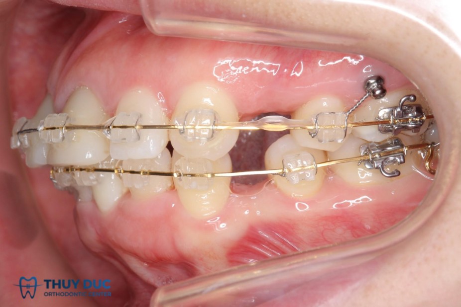 Trường hợp răng cửa lung lay khi niềng là bình thường 1