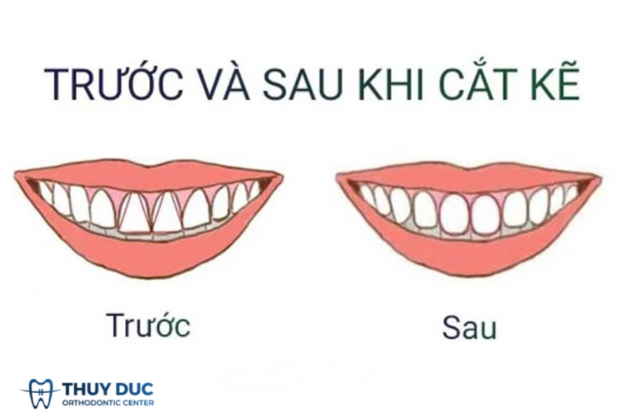 Mục đích của mài kẽ răng là gì? 1