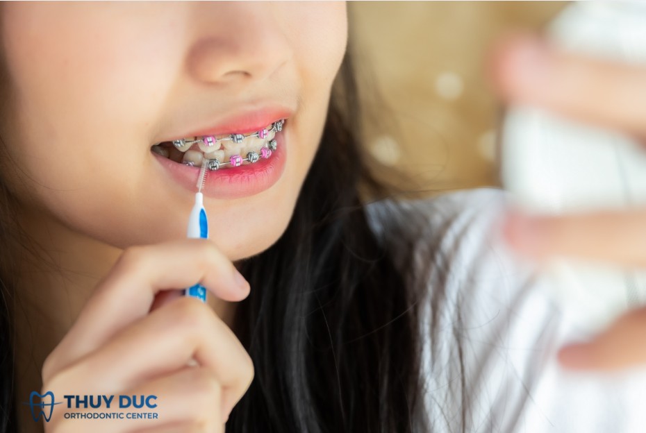 Cách chăm sóc răng miệng khi niềng răng 1