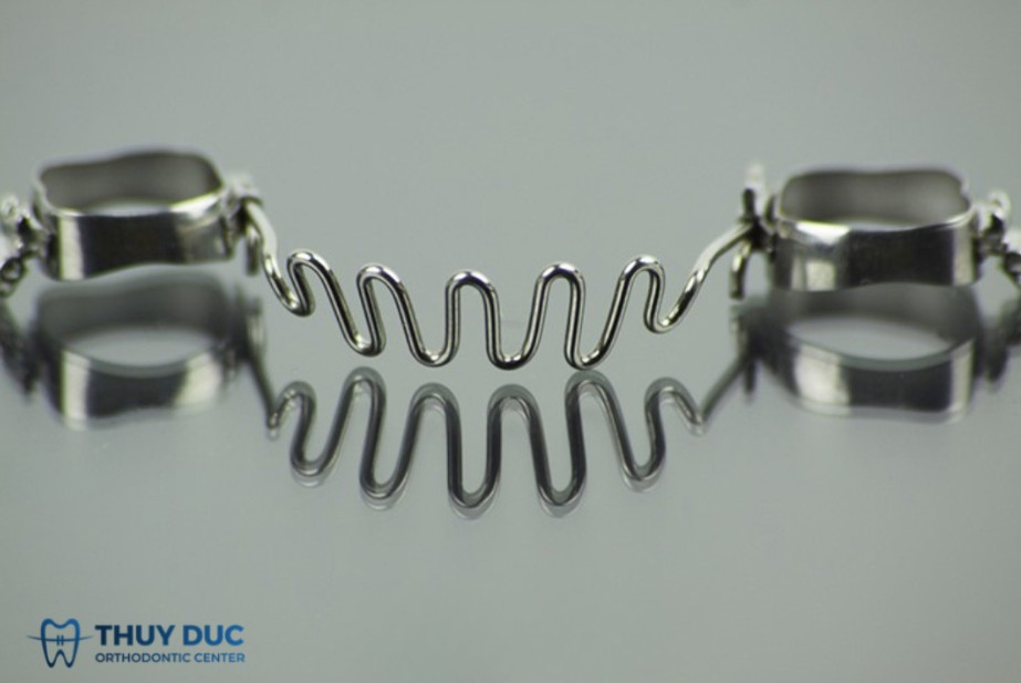 Band niềng răng được gắn trong thời gian bao lâu? 1