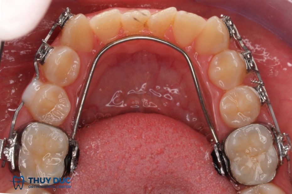 1. Band có độ bền và độ ổn định cao hơn 1