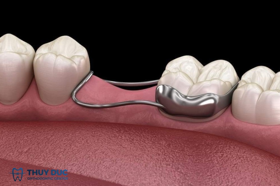 1. Người cần lực kéo mạnh hoặc khí cụ đặc biệt 1