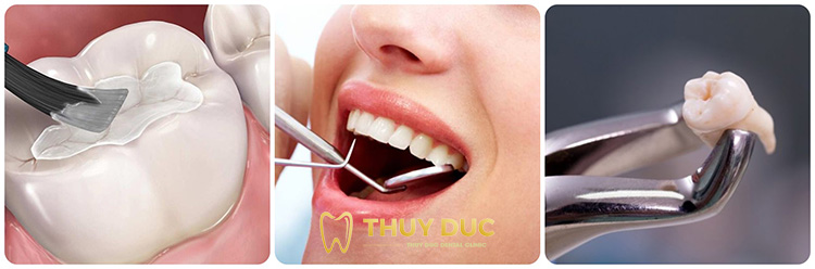 Những cách trị đau răng tận gốc tại nha khoa 1