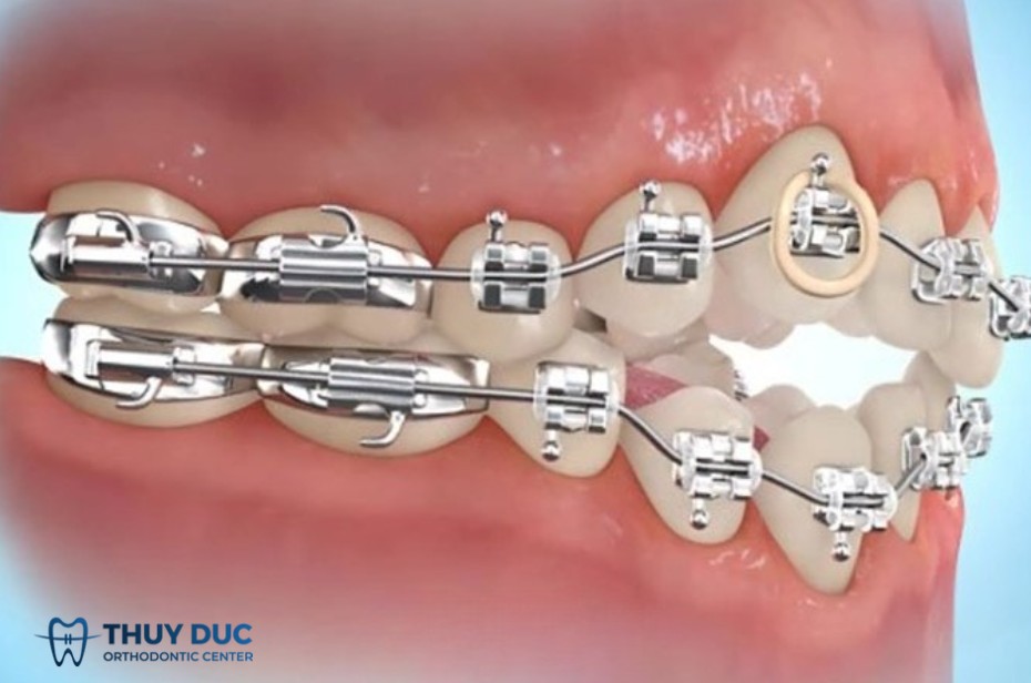 Những công dụng tuyệt vời của band niềng răng 1