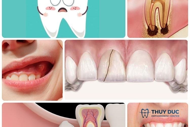 Nguyên nhân gây tình trạng răng khôn bị sâu 1