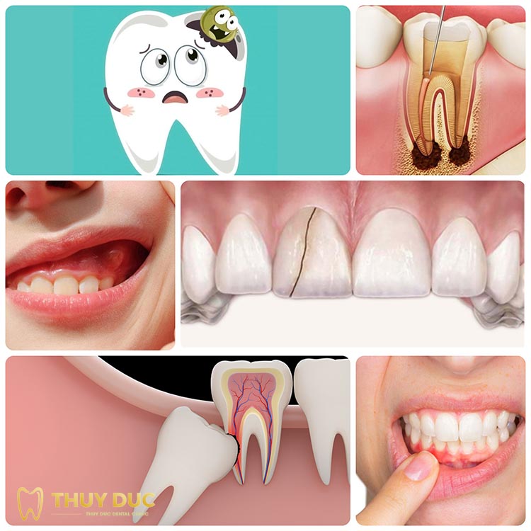 Nguyên nhân đau răng thường gặp 1