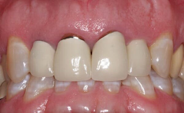 Nguyên nhân sau khi bọc răng sứ bị tụt nướu 1
