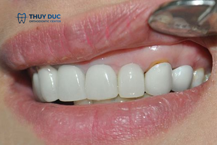 Tụt lợi sau khi bọc răng sứ gây nên những tác hại gì? 1 Tụt lợi sau khi bọc răng sứ gây nên những tác hại gì? 1