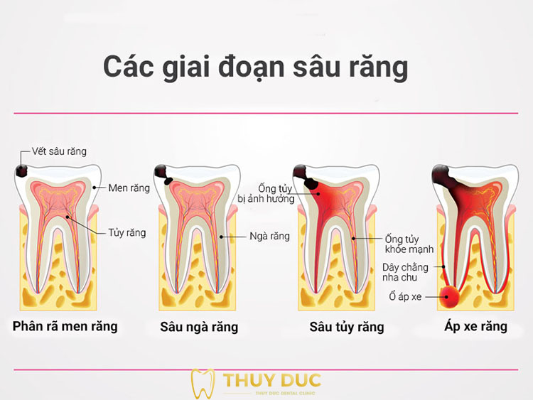 Bị sâu răng hàm phát triển qua những giai đoạn nào? 1