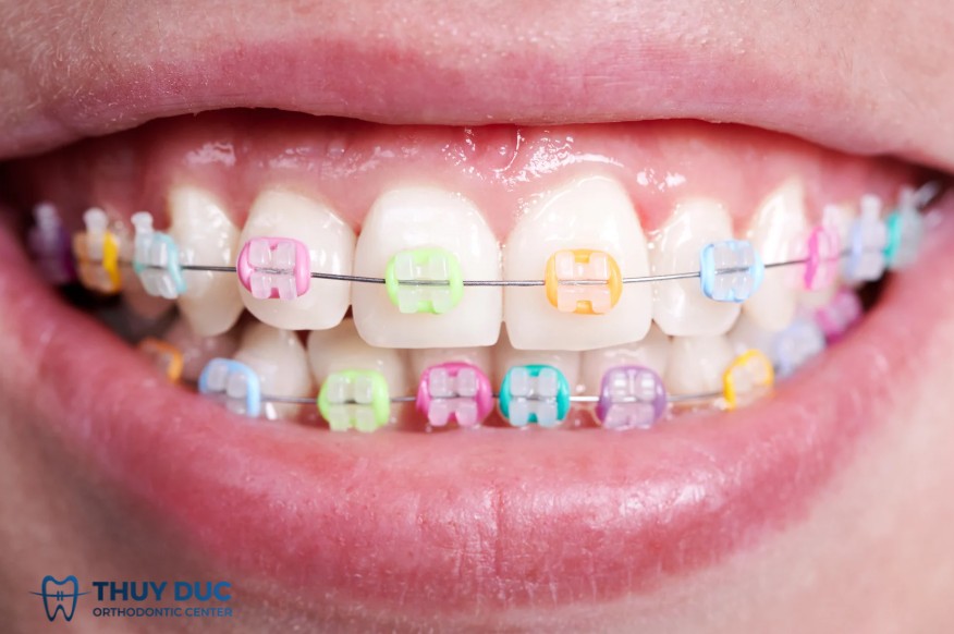 Mắc cài sứ có dễ vỡ không? 1