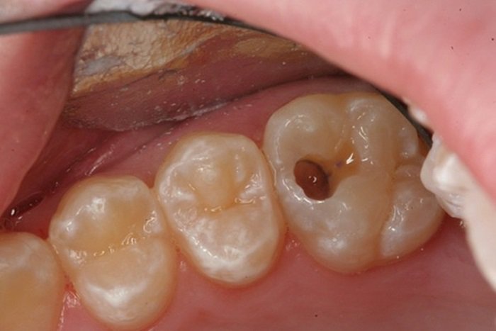 Nang chân răng có dễ dàng phát hiện không? 1
