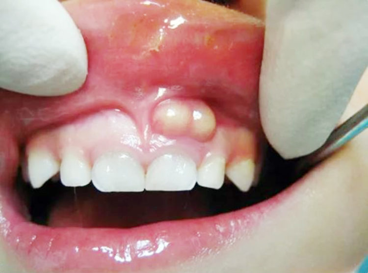 Nang Chân Răng có nguy hiểm không và cách điều trị 1