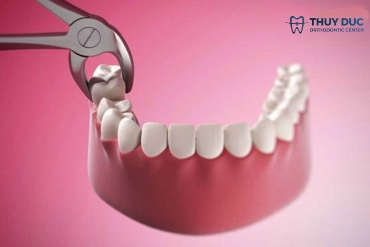 Nhổ răng số 7 trong trường hợp nào? 1 Nhổ răng số 7 trong trường hợp nào? 1