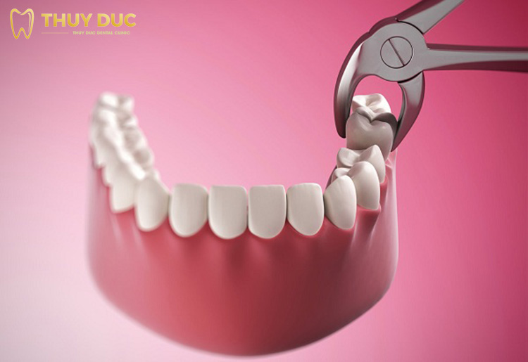Cách nhổ răng hàm bị sâu được thực hiện như thế nào?
