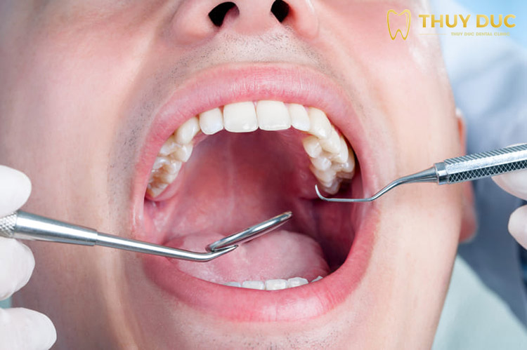 Làm sao để ngăn ngừa rủi ro khi nhổ răng số 7? 1