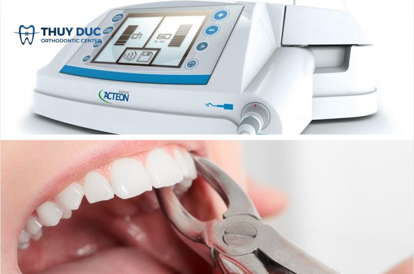 Các phương pháp nhổ răng số 7 hàm dưới 1