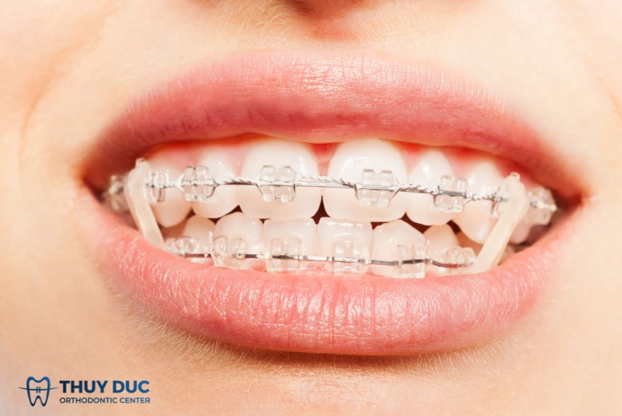 Niềng răng mắc cài sứ 1