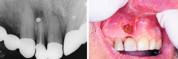 Điều trị nang chân răng như thế nào? 1
