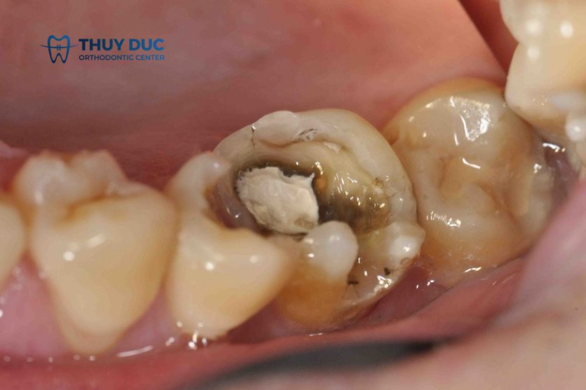 Hậu quả khi bị sâu răng nhưng không điều trị 1