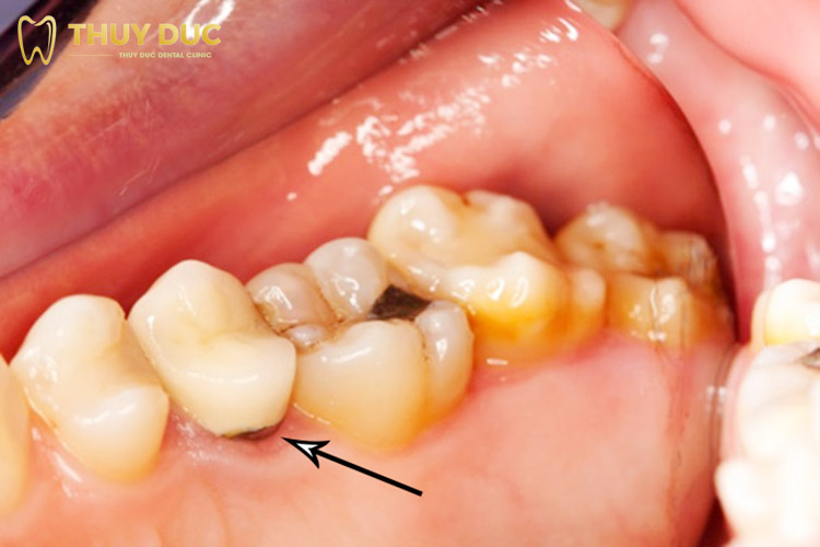 Sâu răng và phương pháp chữa trị sâu răng hiệu quả tại nhà