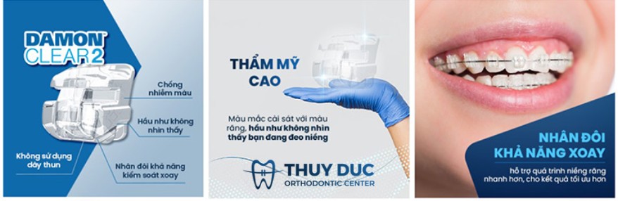 Niềng răng mắc cài sứ ORMCO 1