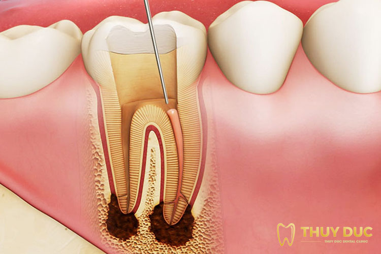 What are the signs and symptoms of severe cavity tooth decay (răng sâu độ 3)?