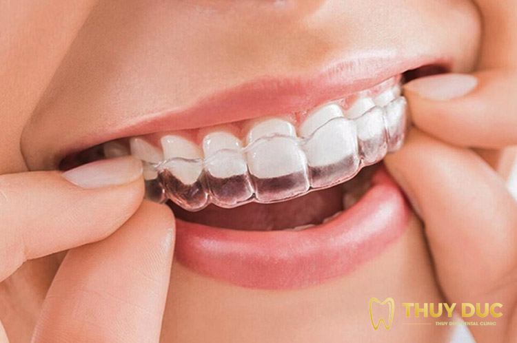 Niềng răng và các phương pháp chỉnh nha mới nhất 3